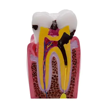 1ks 6 Krát Zubního Kazu Srovnání Modelů Zubního Kazu Model Pro Zubní Studie Výuky Anatomie Vzdělávání Zuby Model