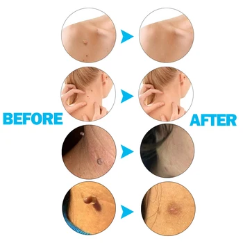 2 Nastavte Tag Krtek, Bradavice Odstraňovač Mikro Skin Remover Kit Domácí Použití Těla Efektivní Péči O Pleť